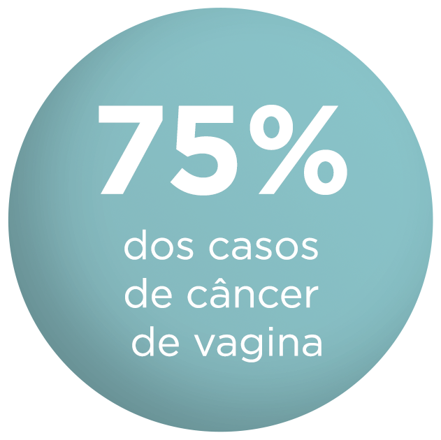 75% dos casos de câncer de vagina